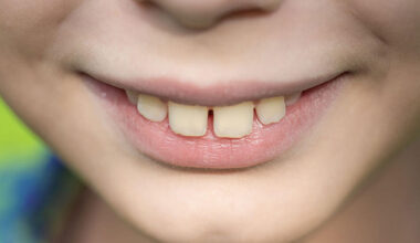 when a bite problem is more than cosmetic