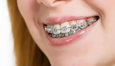 about braces
