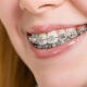 about braces