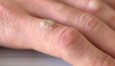 common types of skin warts
