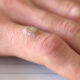 common types of skin warts